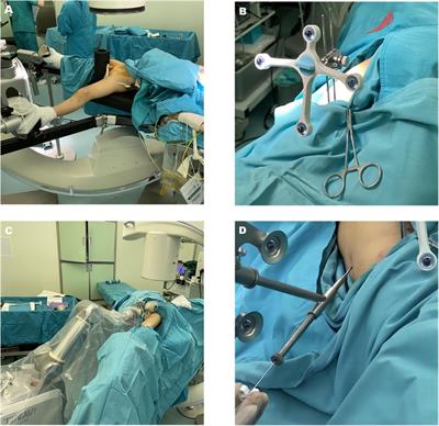 Robot-assisted cannulated compression screw internal fixation for treatment of femoral neck fracture in children: A case series of ten patients